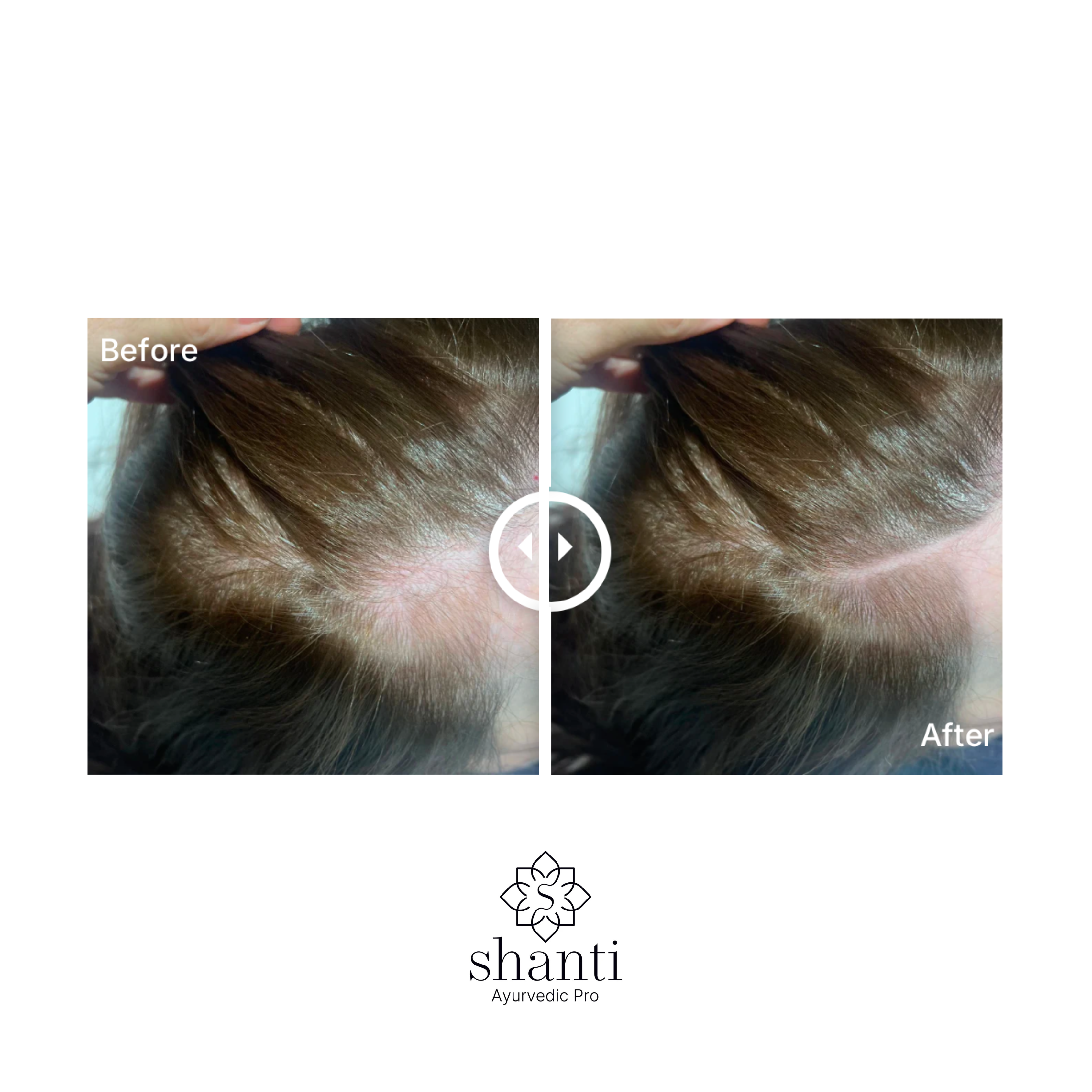 Shanti Peptide Scalp Treatment – scalp serum for hair growth and thicker, fuller hair